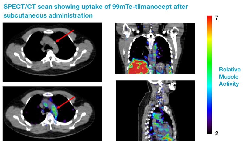 CT scans of the chest showing lit spots where the drug was taken up in the body.